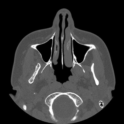Aneurysmal bone cyst of the mandible (Radiopaedia 43280-46823 Axial bone window 113).jpg