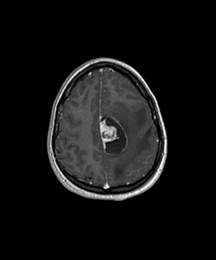 Angiomatous meningioma (Radiopaedia 79459-92577 Axial T1 C+ 3D ISO 40).jpg