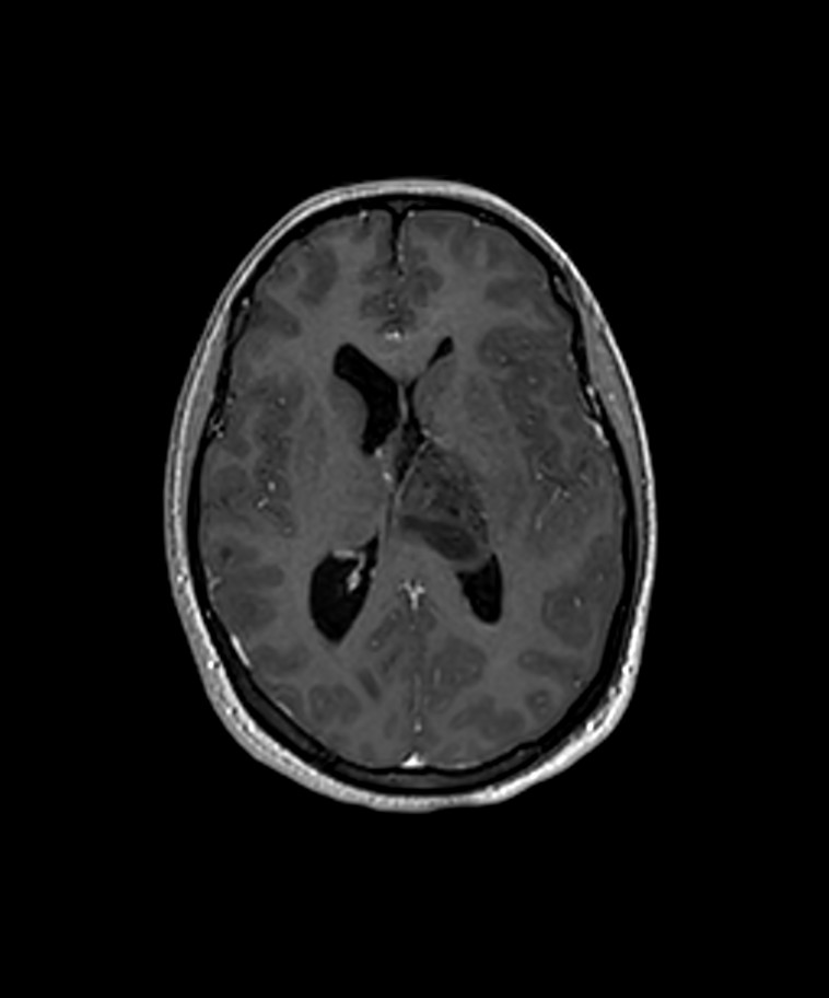 Angiomatous meningioma (Radiopaedia 79459-92577 Axial T1 C+ 3D ISO 7).jpg