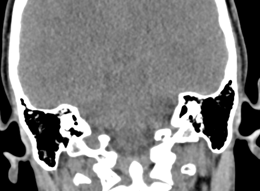 Angular dermoid cyst (Radiopaedia 88967-105790 Coronal non-contrast 83).jpg