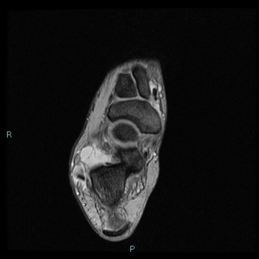 Ankle ganglion cyst (Radiopaedia 62809-71162 Axial Gradient Echo 36).jpg