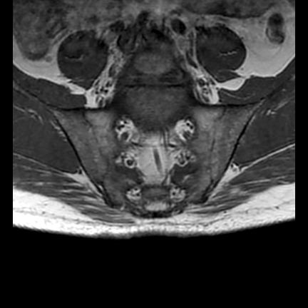 File:Ankylosing spondylitis with zygapophyseal arthritis (Radiopaedia 38433-40517 E 4).jpg