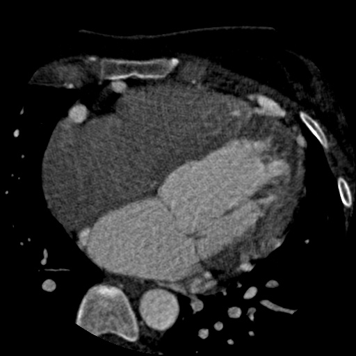 Anomalous left coronary artery from the pulmonary artery (ALCAPA) (Radiopaedia 40884-43586 A 46).jpg
