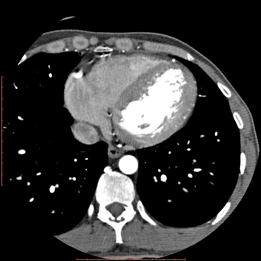Anomalous left coronary artery from the pulmonary artery (ALCAPA) (Radiopaedia 70148-80181 A 273).jpg