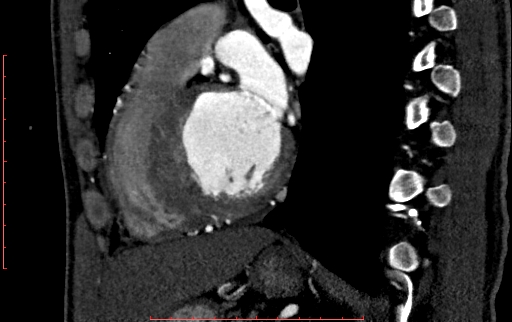 File:Anomalous left coronary artery from the pulmonary artery (ALCAPA) (Radiopaedia 70148-80181 C 156).jpg