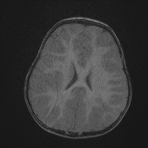 Anoxic brain injury (Radiopaedia 79165-92139 Axial MRA 167).jpg