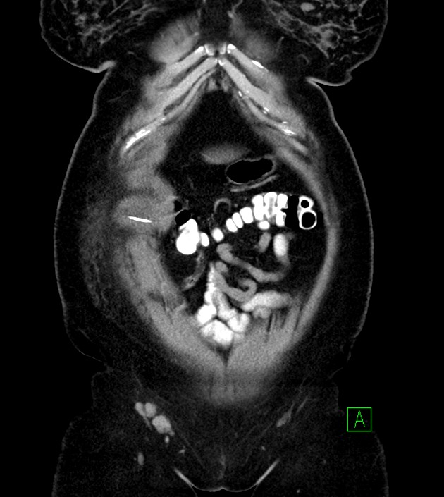 Anterior abdominal wall CSF pseudocyst (CSFoma) (Radiopaedia 79453-92571 B 15).jpg