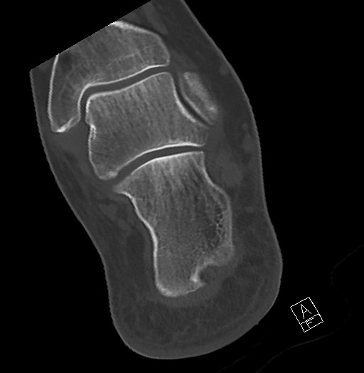 Anterior calcaneal process fracture (Radiopaedia 63353-71943 Axial bone window 106).jpg
