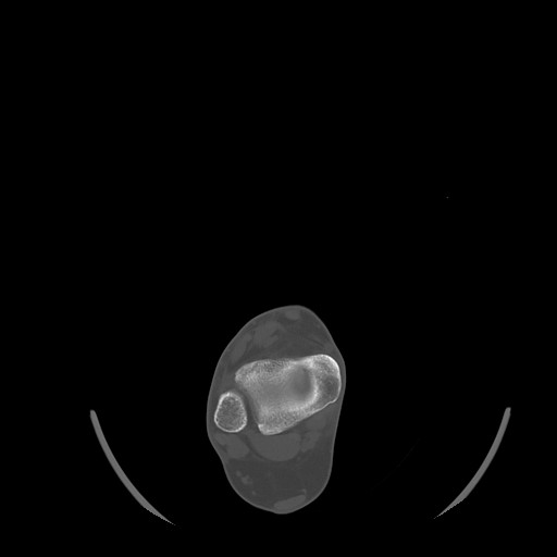 Anterior calcaneal process fracture (Radiopaedia 82590-96762 Axial bone window 10).jpg
