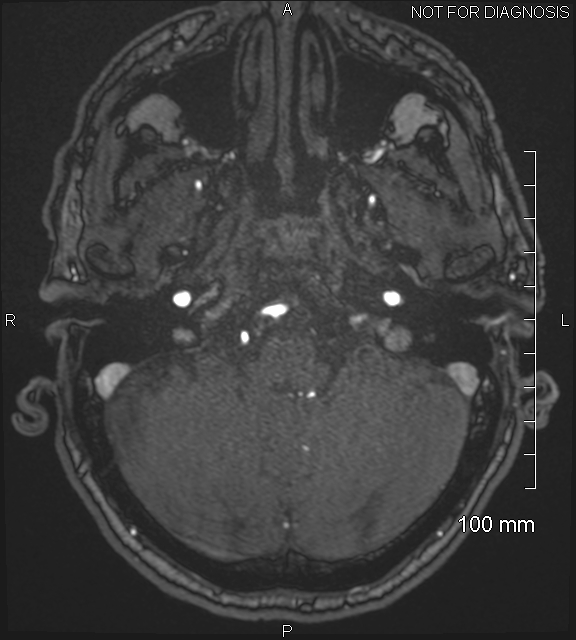 Anterior cerebral artery aneurysm (Radiopaedia 80683-94127 Axial MRA 40).jpg