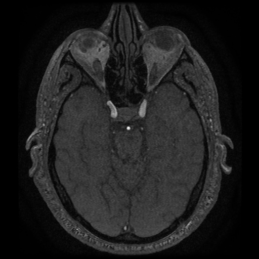 Anterior cerebral artery infarction (Radiopaedia 46794-51323 Axial MRA 61).jpg