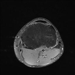 File:Anterior cruciate ligament full thickness tear (Radiopaedia 66268-75467 Axial PD fat sat 23).jpg