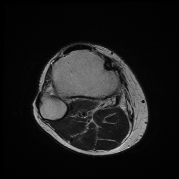 File:Anterior cruciate ligament graft tear and bucket-handle tear of medial meniscus (Radiopaedia 75867-87255 Axial T2 1).jpg