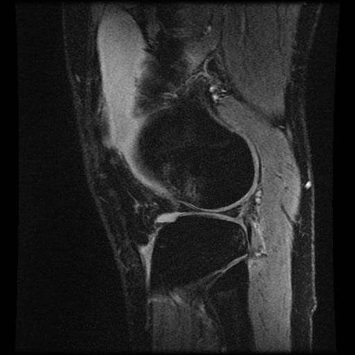 Anterior cruciate ligament tear (Radiopaedia 61500-69462 F 73).jpg
