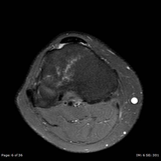 File:Anterior cruciate ligament tear (Radiopaedia 70783-80964 Axial PD fat sat 6).jpg
