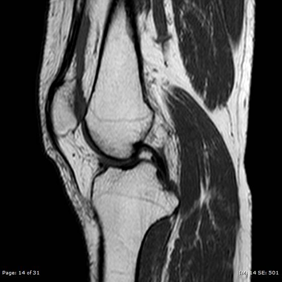 File:Anterior cruciate ligament tear (Radiopaedia 70783-80964 Sagittal T1 14).jpg