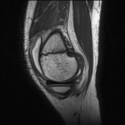 File:Anterior cruciate ligament tear - pediatric (Radiopaedia 62152-70260 Sagittal PD 38).jpg
