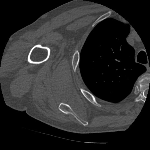 Anterior glenohumeral dislocation with Hill-Sachs lesion (Radiopaedia 62877-71249 Axial bone window 62).jpg