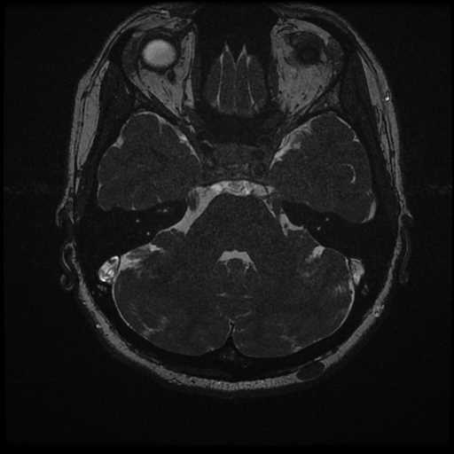 Anterior inferior cerebellar artery vascular loop - type II (Radiopaedia 70991-81209 Axial 3D FIESTA 23).jpg