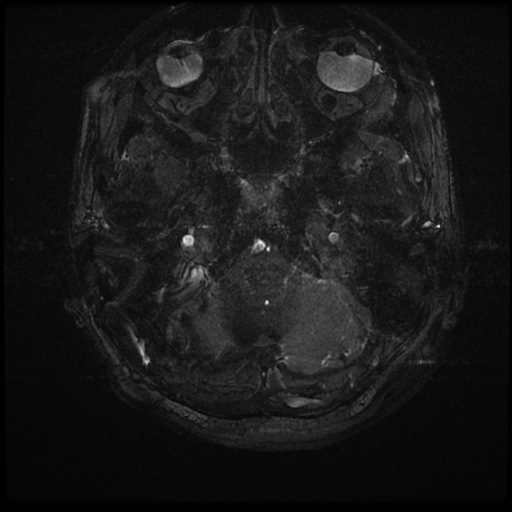 Anterior inferior cerebellar artery vascular loop - type II (Radiopaedia 70991-81209 Axial 3D FIESTA 80).jpg