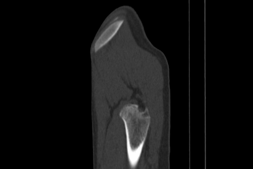 Anterior inferior iliac spine avulsion injury (Radiopaedia 88666-105376 Sagittal bone window 89).jpg