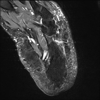 File:Anterior talofibular ligament injury - rupture with soft-tissue impingement (Radiopaedia 38765-40928 Axial T2 fat sat 33).jpg