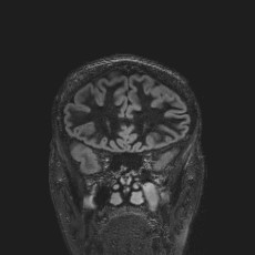 Anterior temporal encephalocele (Radiopaedia 82624-96808 Coronal FLAIR 13).jpg