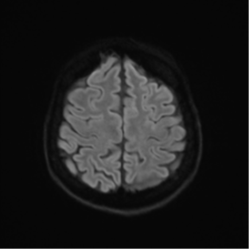 Anterior temporal lobe perivascular space (Radiopaedia 40946-43650 Axial DWI 49).png