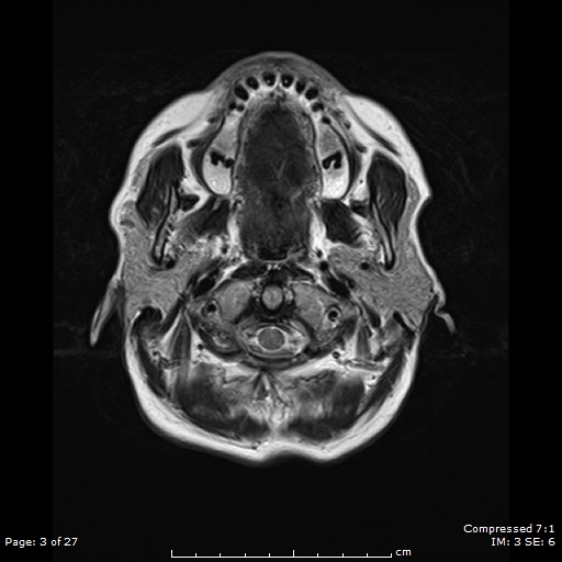 File:Anterior temporal lobe perivascular space (Radiopaedia 88283-104914 Axial T2 3).jpg