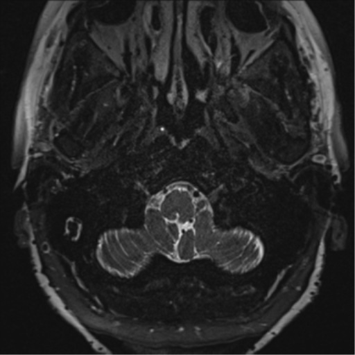 Anterior temporal pole cysts (Radiopaedia 46629-51102 Axial T2 1).png