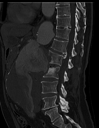 File:Anterior vertebral scalloping (abdominal aortic aneurysm) (Radiopaedia 66744-76067 Sagittal bone window 30).jpg