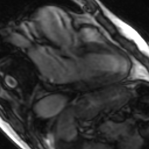 File:Anteroseptal hypokinesia after myocardial infarction (Radiopaedia 15978-15633 3 chamber view SSFE 28).jpg