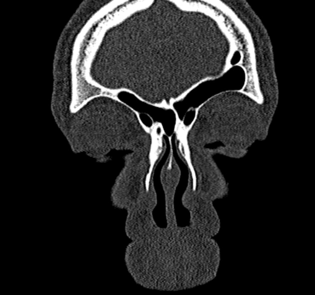 File:Antrochoanal polyp (Radiopaedia 30002-30554 Coronal bone window 16).jpg