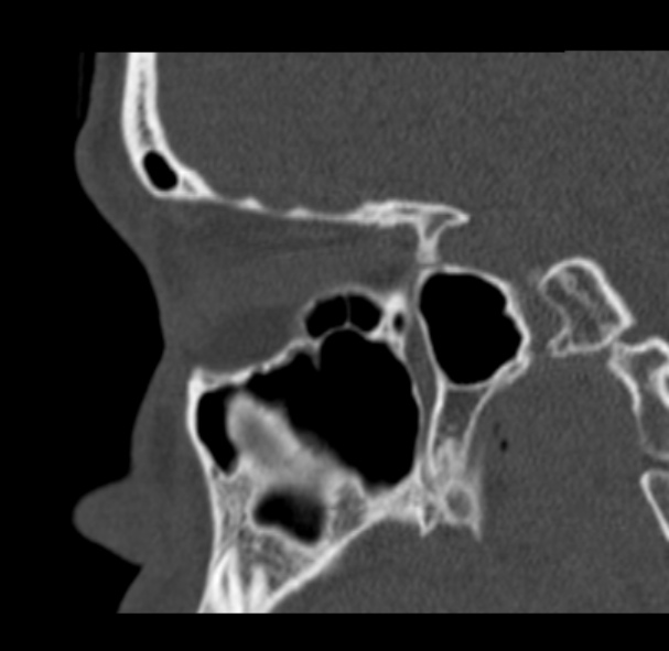Antrochoanal polyp (Radiopaedia 33984-35202 Sagittal bone window 55).jpg