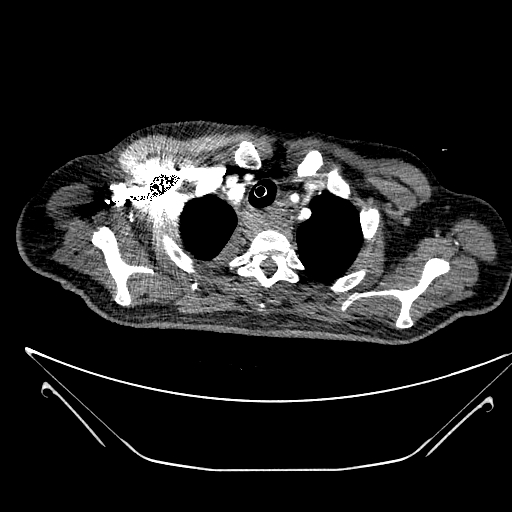 Aortic arch aneurysm (Radiopaedia 84109-99365 B 97).jpg