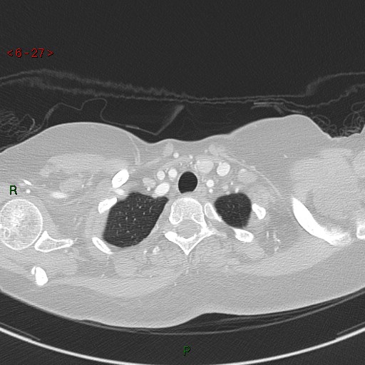Aortic arch origin of left vertebral artery (Radiopaedia 51520-57286 Axial lung window 27).jpg