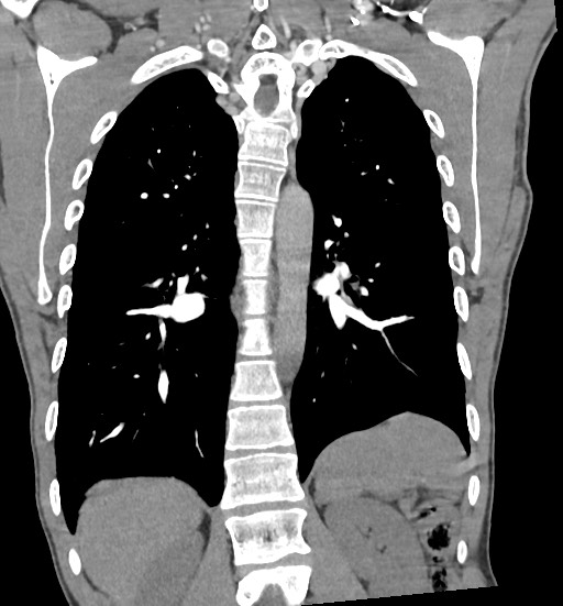 File:Aortic coarctation with aneurysm (Radiopaedia 74818-85828 C 82).jpg