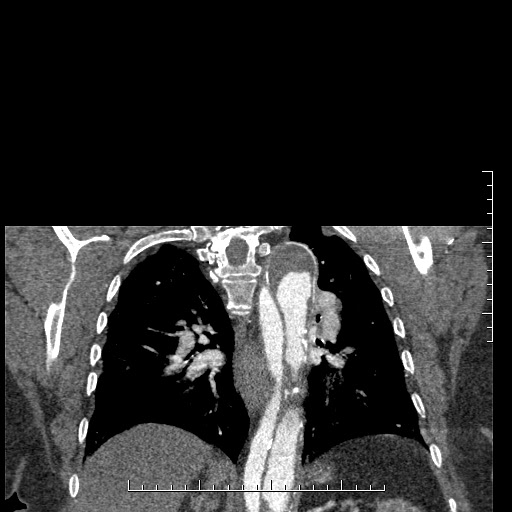 File:Aortic dissection- Stanford A (Radiopaedia 35729-37268 E 11).jpg