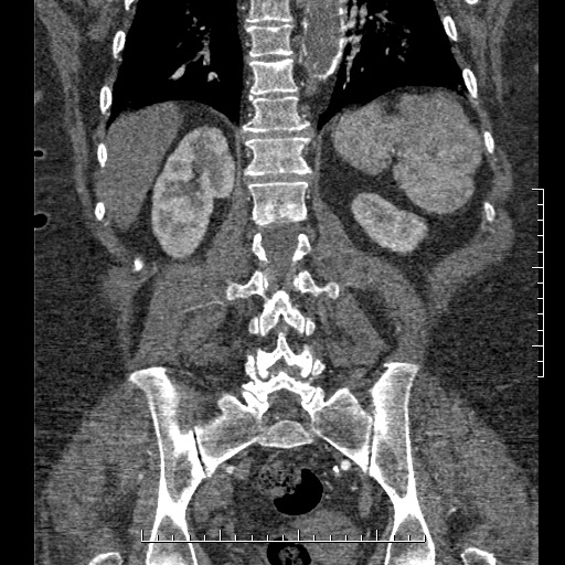 Aortic dissection- Stanford A (Radiopaedia 35729-37268 F 6).jpg