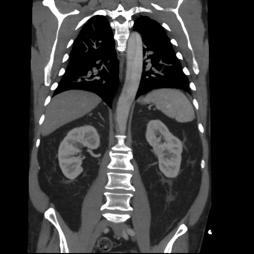File:Aortic dissection- Stanford A (Radiopaedia 37759-39664 Coronal C+ delayed 34).png