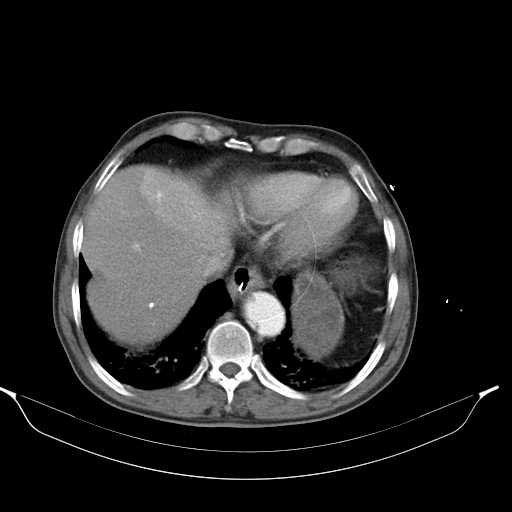 Aortic dissection- Stanford type A (Radiopaedia 22085-22085 A 33).jpg