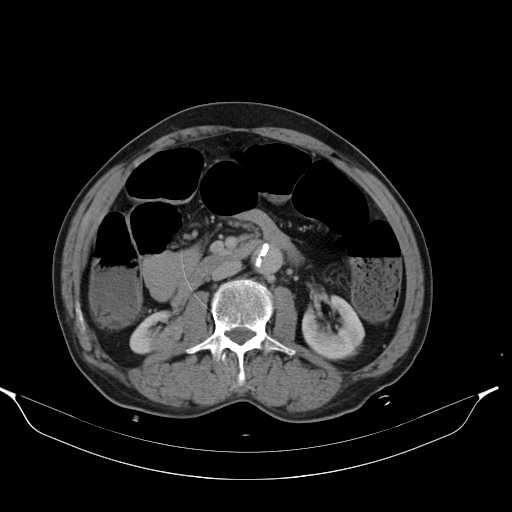 File:Aortic dissection- Stanford type A (Radiopaedia 22085-22085 Axial C+ delayed 24).jpg