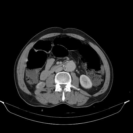 File:Aortic dissection- Stanford type A (Radiopaedia 22085-22085 Axial C+ delayed 27).jpg