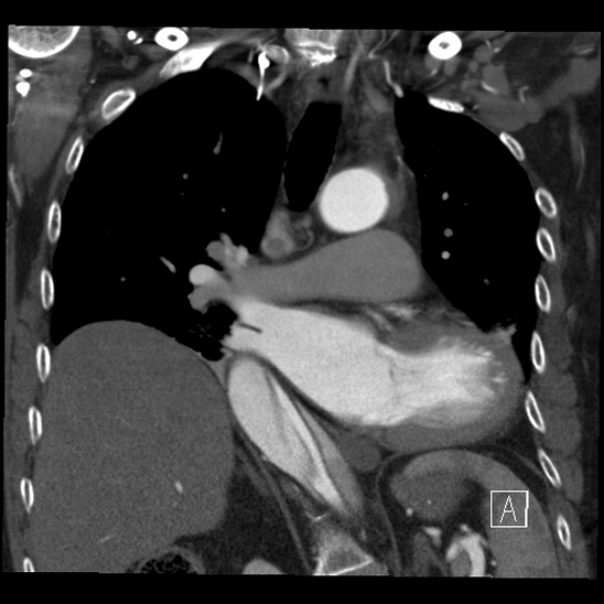 Aortic dissection (CTPA) (Radiopaedia 75506-86750 B 36).jpg