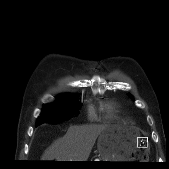 Aortic dissection (CTPA) (Radiopaedia 75506-86750 B 8).jpg