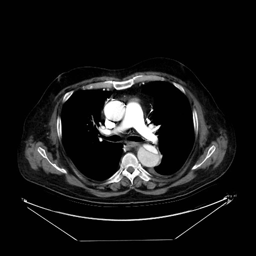 Aortic dissection (Radiopaedia 62562-71000 A 15).jpg