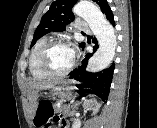 Aortic dissection - Stanford A -DeBakey I (Radiopaedia 28339-28587 C 59).jpg