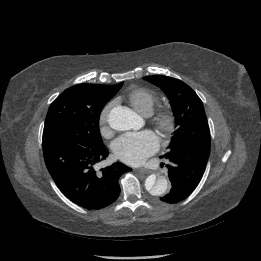Aortic dissection - Stanford type B (Radiopaedia 88281-104910 A 48).jpg
