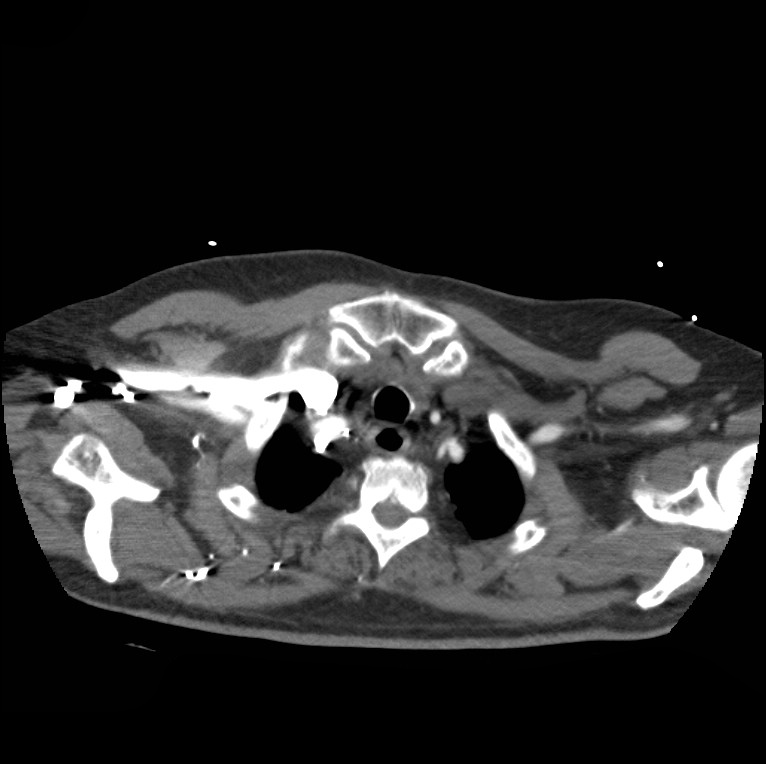 Aortic dissection with rupture into pericardium (Radiopaedia 12384-12647 A 8).jpg