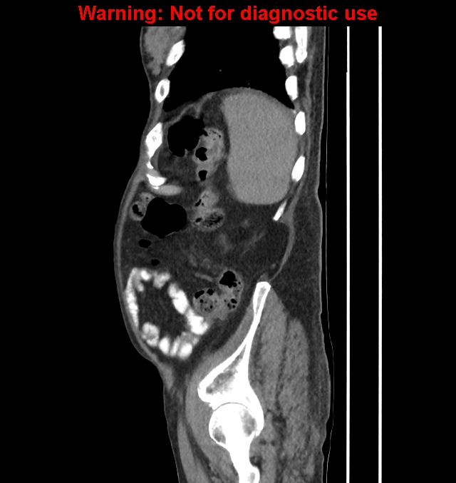 Aortic graft infection (Radiopaedia 44979-48907 C 14).jpg